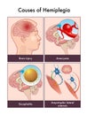 Hemiplegia illustration