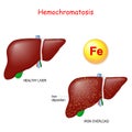 Hemochromatosis or Iron overload. Healthy liver and liver with iron deposits