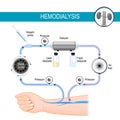 Hemodialysis machine. Dialysis process