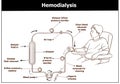 Hemodialysis procedure. Used for the renal insufficiency. Royalty Free Stock Photo