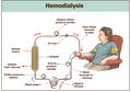 Hemodialysis procedure. Used for the renal insufficiency Royalty Free Stock Photo