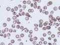 Hemoglobin SC disease.