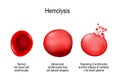 Hemolysis. Normal red blood cell, spherocyte, and rupturing of e