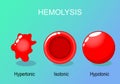 Hemolysis of Red blood cells Royalty Free Stock Photo