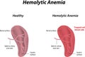 Hemolytic Anemia Royalty Free Stock Photo