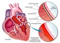 Hemopericardium