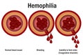 Hemophilia. damaged blood vessel concept isolated