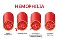 Hemophilia. damaged blood vessel, Haemophilia Coagulation disorder - Vector Royalty Free Stock Photo