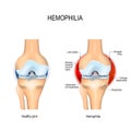 Human knee with hemophilia and healthy joint