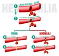 Hemophilia Infographics Poster Royalty Free Stock Photo
