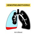 Hemopneumothorax medical poster