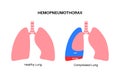 Hemopneumothorax medical poster