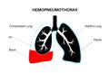 Hemopneumothorax medical poster