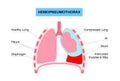 Hemopneumothorax medical poster