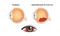 Hemorrhage in the eye, vector medical illustration