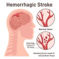 Hemorrhagic brain stroke concept. Hemorrhage in the brain, rupture