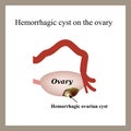 Hemorrhagic cyst on the ovary. Ovary. Infographics.