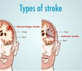 Vector illustration of a Hemorrhagic and ischemic stroke Royalty Free Stock Photo