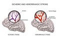 Hemorrhagic and ischemic stroke
