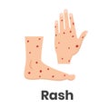 Hemorrhagic rash icon on feet and hands