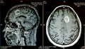 Hemorrhagic stroke