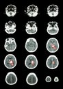 Hemorrhagic Stroke . CT scan (computed tomography) of brain ( c Royalty Free Stock Photo