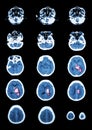 Hemorrhagic Stroke . CT scan (computed tomography) of brain ( c