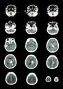 Hemorrhagic Stroke . CT scan (computed tomography) of brain ( c