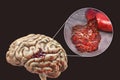 Hemorrhagic stroke, illustration