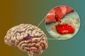 Hemorrhagic stroke, illustration