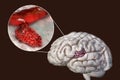 Hemorrhagic stroke, illustration