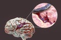 Hemorrhagic stroke, illustration