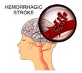Hemorrhagic stroke Royalty Free Stock Photo