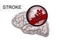 Hemorrhagic stroke. insult. rupture of the vessel Royalty Free Stock Photo