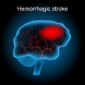 Hemorrhagic stroke. human brain with blood vessels and hematoma