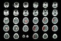 Hemorrhagic Stroke and Ischemic Stroke . CT scan of brain : intracerebral hemorrhage ( 3 left column , cerebral infarction ( 3 ri Royalty Free Stock Photo