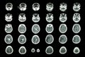 Hemorrhagic Stroke and Ischemic Stroke