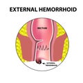 Hemorrhoids external. Rectum structure. Intestines. colon. Internal hemorrhoidal node. Infographics. Vector illustration