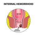 Hemorrhoids internal. Rectum structure. Intestines. colon. Internal hemorrhoidal node. Infographics. Vector illustration