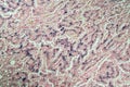 Hemosiderosis liver under a microscope Royalty Free Stock Photo