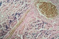 Hemosiderosis liver under a microscope Royalty Free Stock Photo