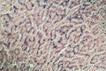 Hemosiderosis liver under a microscope Royalty Free Stock Photo