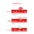 Hemostasis. Basic steps of wound healing process Royalty Free Stock Photo