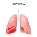 Hemothorax. Collapsed lung Royalty Free Stock Photo