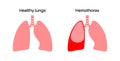 Hemothorax medical poster