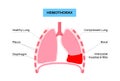 Hemothorax medical poster