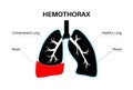 Hemothorax medical poster