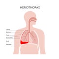 Hemothorax medical poster