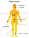 Hepatic cirrhosis