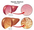 Hepatic steatosis